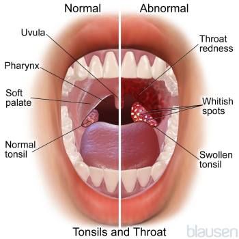 throat disorders