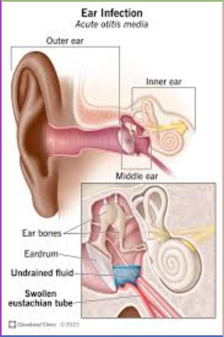 Ear infection 